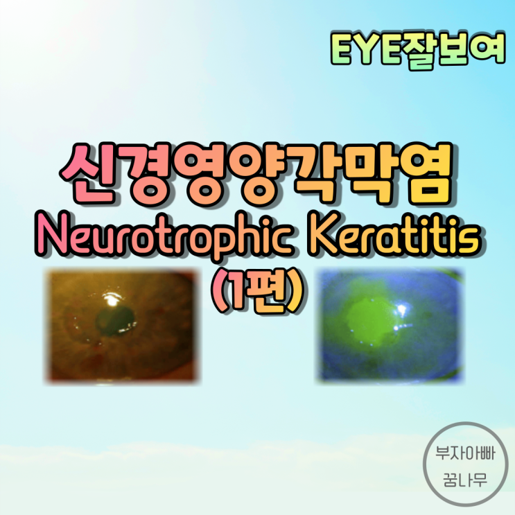 [EYE잘보여] 신경영양 각막염(Neurotrophic Keratitis), 신경영양 궤양(Neurotrophic Ulcer) (1) - 원인, 발생기전, 임상증상(임상양상)