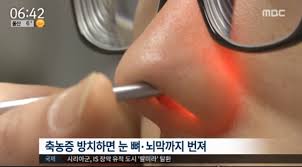  축농증 원인증상 진단검사 약물수술치료 콧물코막힘 부비동염합병증 비염코골이 염증고름 간호진단과정