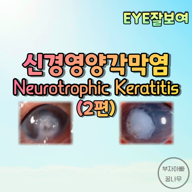 [EYE잘보여] 신경영양 각막염(Neurotrophic Keratitis), 신경영양 궤양(Neurotrophic Ulcer) (2) - 진단, 치료
