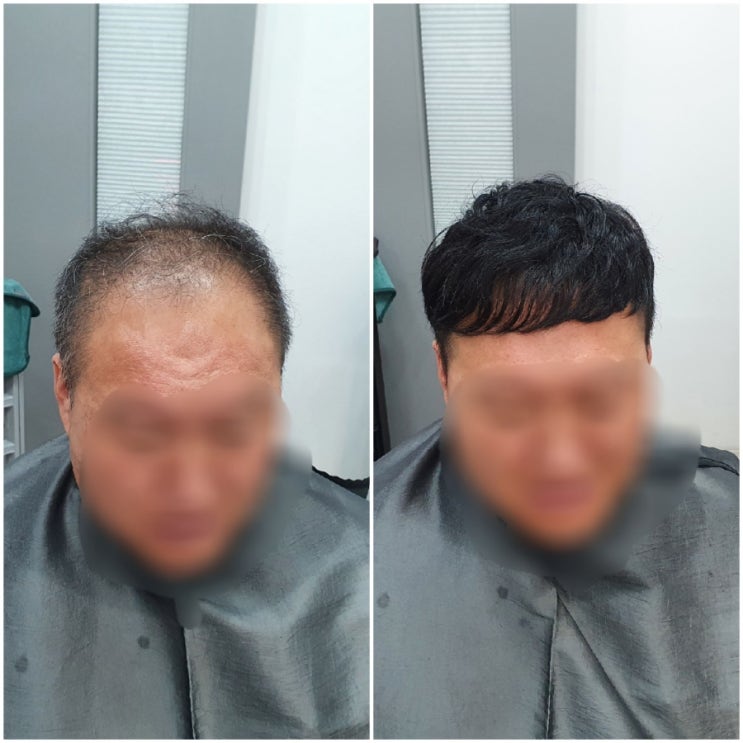  헤어이식증모 남자도만들어진다!
