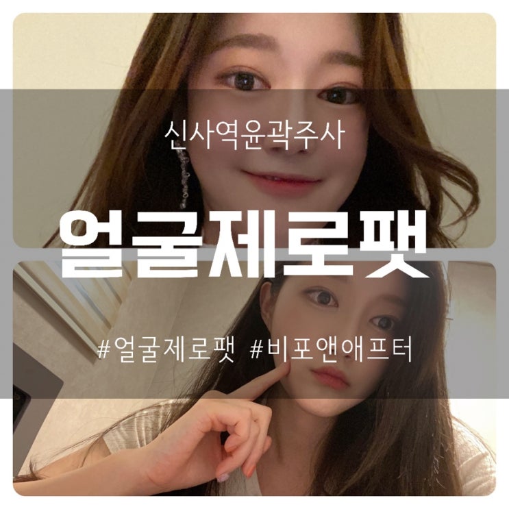  신사역윤곽주사::  볼살 빵빵에 효과만점 얼굴지방분해주사효과 최고 얼굴제로팻 주사 등장! <스테로이드 없음>