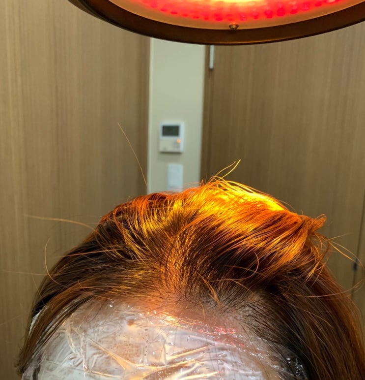  압구정 탈모치료(헤어진, 셀피어스,모낭주사) 디앤에이에서 편하게 받았어요