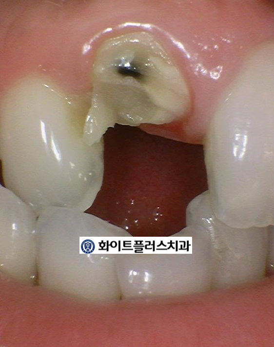 자연치아 살리는 보라매역 치과 - 뿌리만 남은 치아 살리기