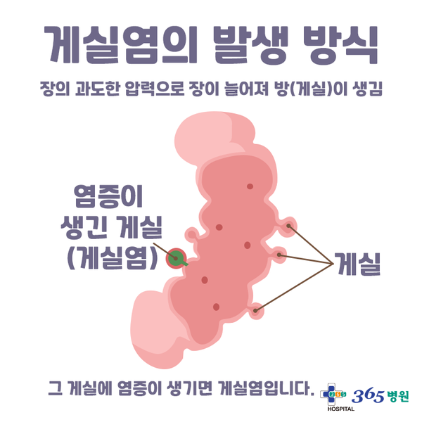 [창원마산 척추관절 디스크 365병원] 게실염