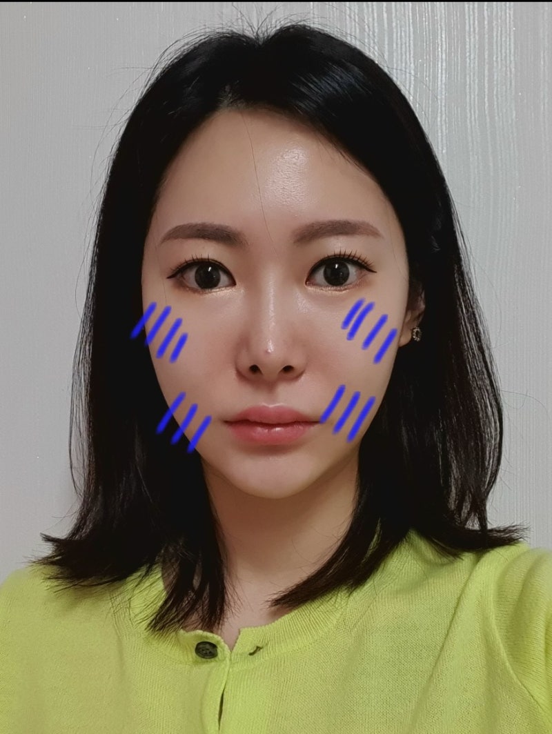 윤곽주사 전후 이중턱 정리 후기 공유!