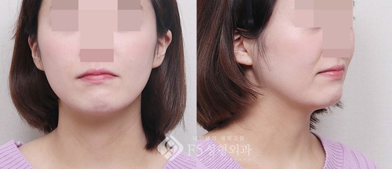 윤곽수술 후 무턱이 개선되지 않는다면 : 샌드위치절골로 턱끝전진술 턱재수술 실제수술전후사진