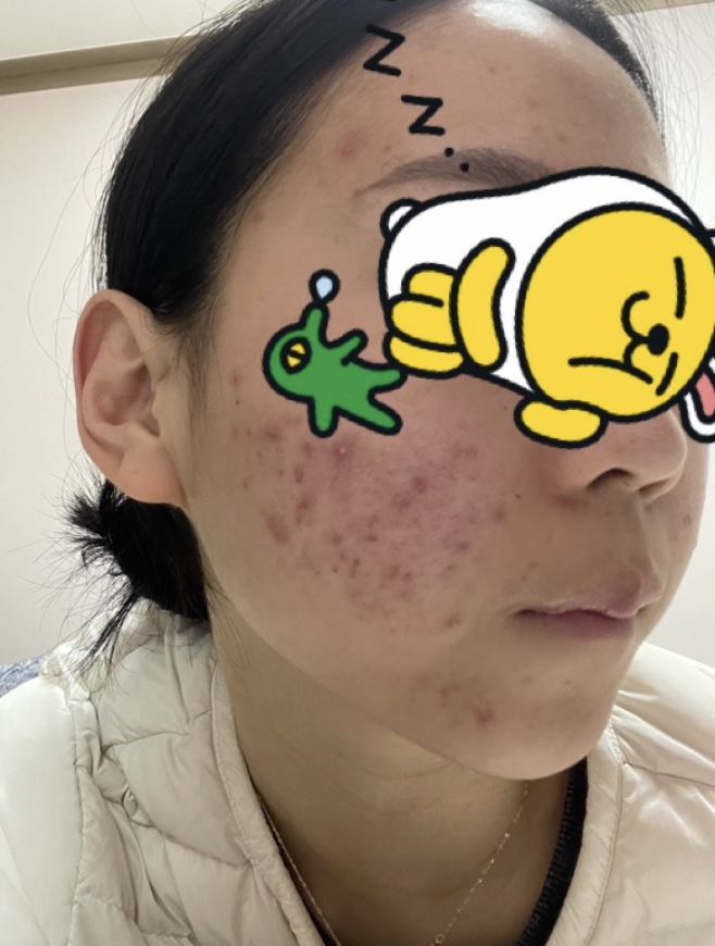  비대면 1:1 피부 무료 상담! 눈에 보이는 효과! 달라진 피부!