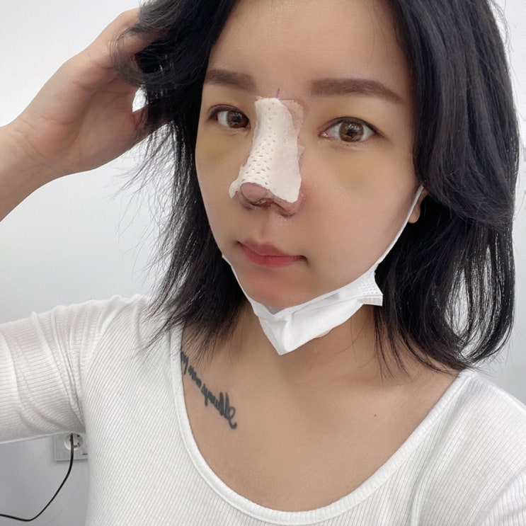  내돈내산 복코재수술!!! 수술당일~수술3일차