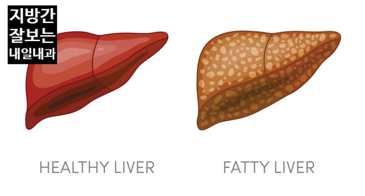 기름진 간 다이어트 하기 : 지방간 잘 보는 내일내과