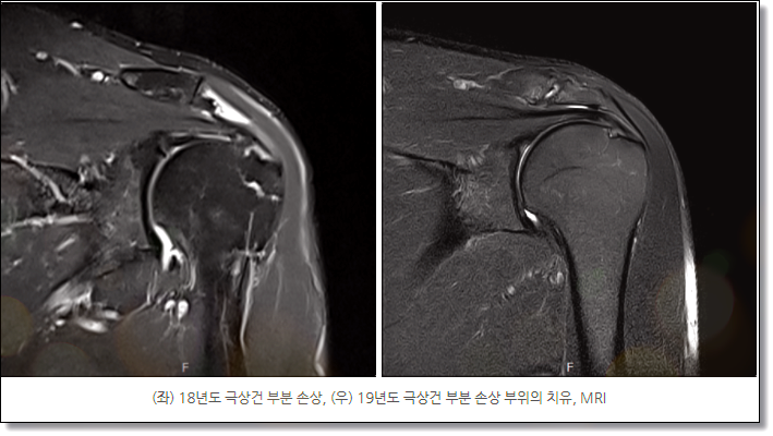 어깨회전근개파열명의? 전문의가 말하는 진실