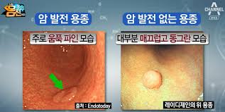  위 용종 원인증상 모양특징 내시경검사치료 용종제거수술 예후경과합병증 위종양위암선종 간호중재케이스