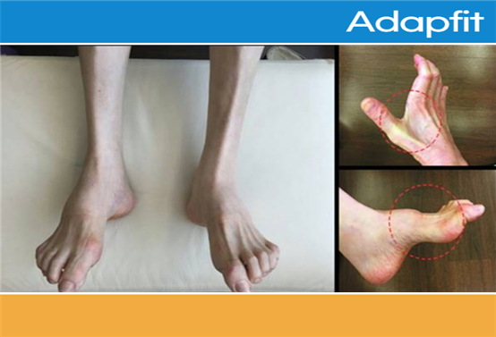 손과 발이 약해지는 신경계 희귀 질환 샤르코 마리 투스의 특징