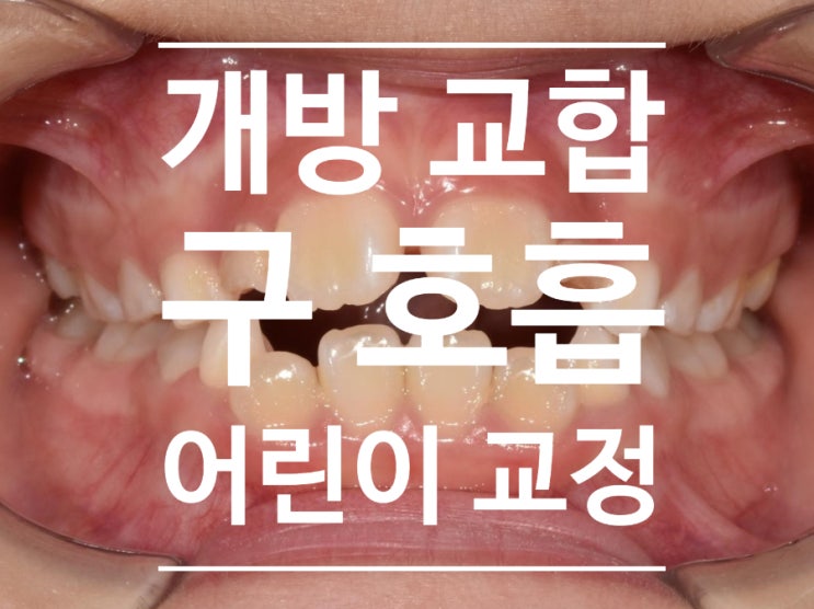 미사 교정치과) 어린이 구호흡 개방교합 개선하기, 바른 얼굴 만들기 프로젝트 미사 교정치과) 어린이 구호흡 개방교합 개선하기, 바른 얼굴 만들기 프로젝트