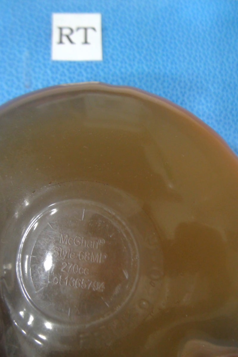 갑상선수술 후 합병증 _ 성대마비\u003e 갑상선암을 치료하기 위해서 가장 중요하고 기본적인 치료 방법은 수술입니다. 갑상선암 수술은 다른 암  수술, 에를 들어 두경부암 수술이나 두경부암 재건 수술에 비해 간단한 편입니다. 물론, 수술에 따른, image size:800x1201