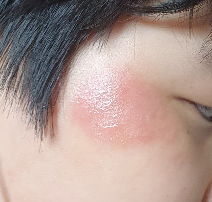 얼굴 찰과상_초기 치료가 중요해요! 자외선 NO! 얼굴 찰과상_초기 치료가 중요해요! 자외선 NO!