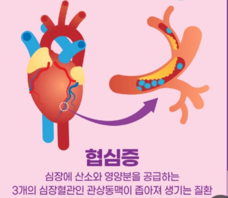 협심증 심장 스탠트 시술 경험담
