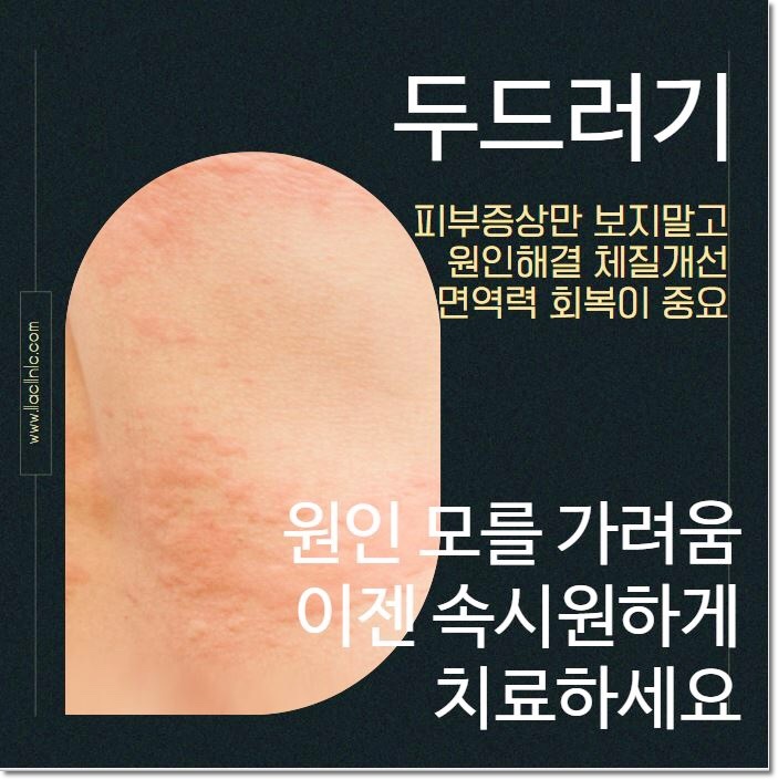 인천두드러기한의원 항히스타민제를 먹어도 가렵다면 인천두드러기한의원 항히스타민제를 먹어도 가렵다면
