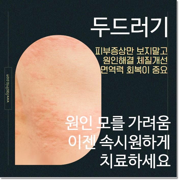 인천두드러기한의원 항히스타민제를 먹어도 가렵다면