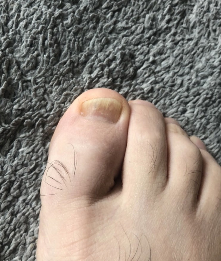  핀포인트 레이져 3개월차