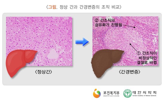  간경화증 치료단계목표 약물식단관리 간이식수술 간경화진행단계 부종복수간암합병증 간호중재진단