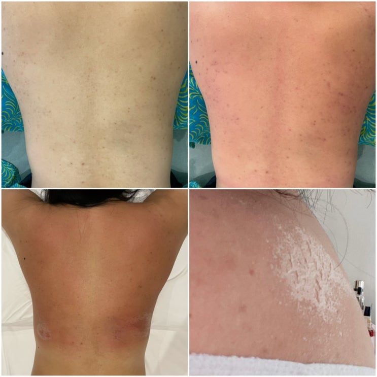  중랑구피부관리 세리영스킨케어 로즈드메르 등필링 후기(통증, 간지러움, 탈각 등)