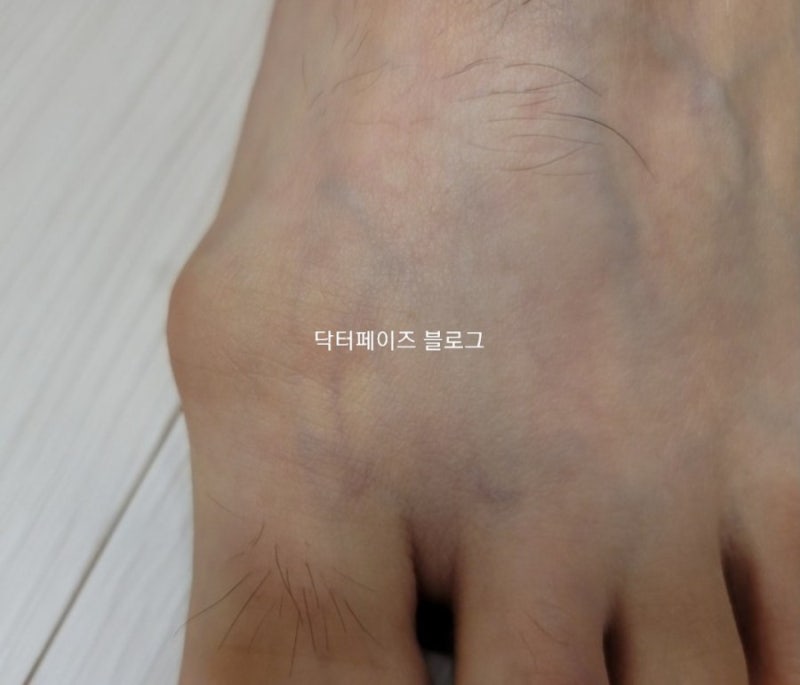 털과의 전쟁 가정용 레이저 제모기 유라이크 후기 마이홈내산 (전부 알아버려..)