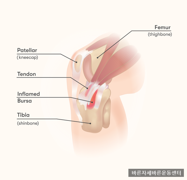  [거위발 건염] 계단을 오를때마다 무릎이 아파요...