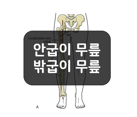 무릎관절의 일반적 해부학 - 밖굽이 무릎(genu valgum), 안굽이 무릎(genu varum)