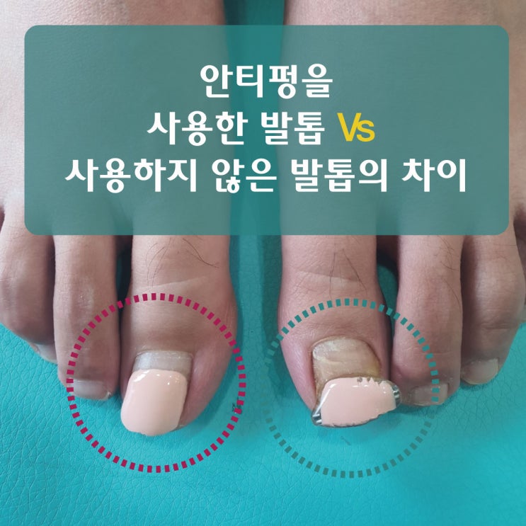  무좀발톱 홈케어 관리에 안티펑세럼을 사용한 사례들 발톱무좀이 있는 상태에서 바로 사용할 수 있는 내성발톱 관리에 효과적인 쉬운 방법 소개