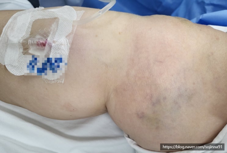  약물의 혈관외 유출(일혈, extravasation)이란 무엇이고 발생하는 합병증과 문제가 되는 약물은?-(1)
