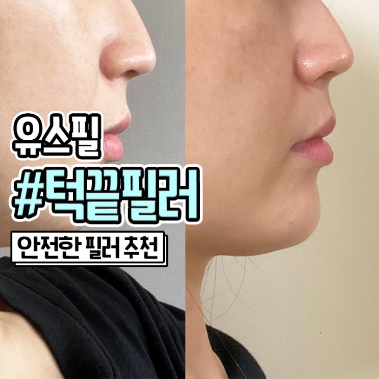  부산피부과 유스필 턱끝필러 가격, 사진 有