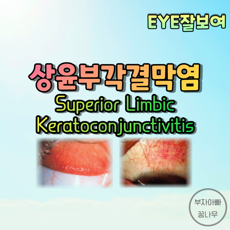  [EYE잘보여] 상윤부각결막염(Superior Limbic Keratoconjunctivitis; SLK) - 정의, 발병기전, 원인, 증상(임상양상), 진단, 치료
