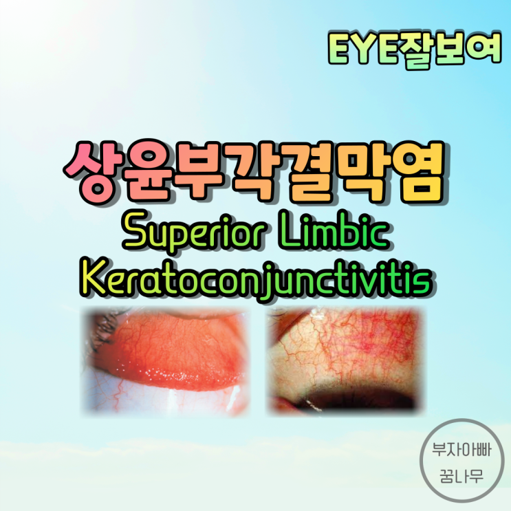 [EYE잘보여] 상윤부각결막염(Superior Limbic Keratoconjunctivitis; SLK) - 정의, 발병기전, 원인, 증상(임상양상), 진단, 치료