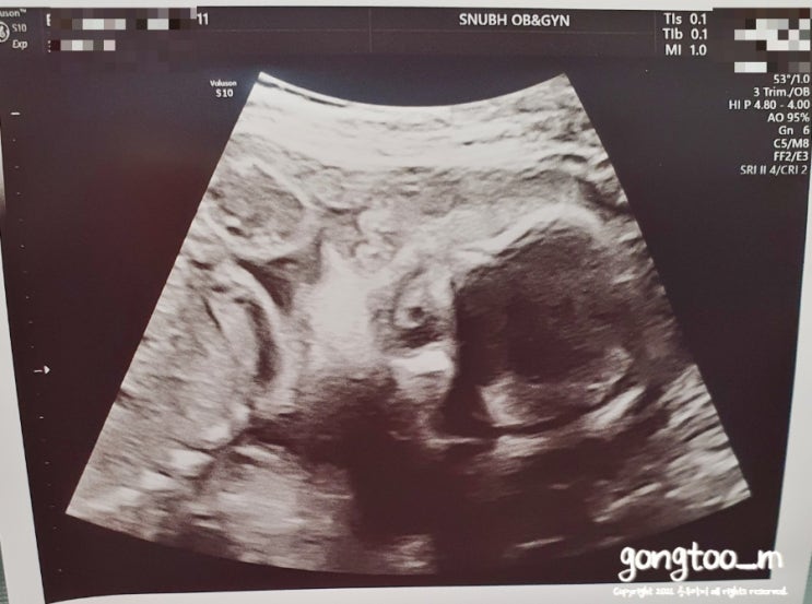 임신 25주+6일 :: 임당검사 통과! / 초음파사진 / 25주 태아몸무게