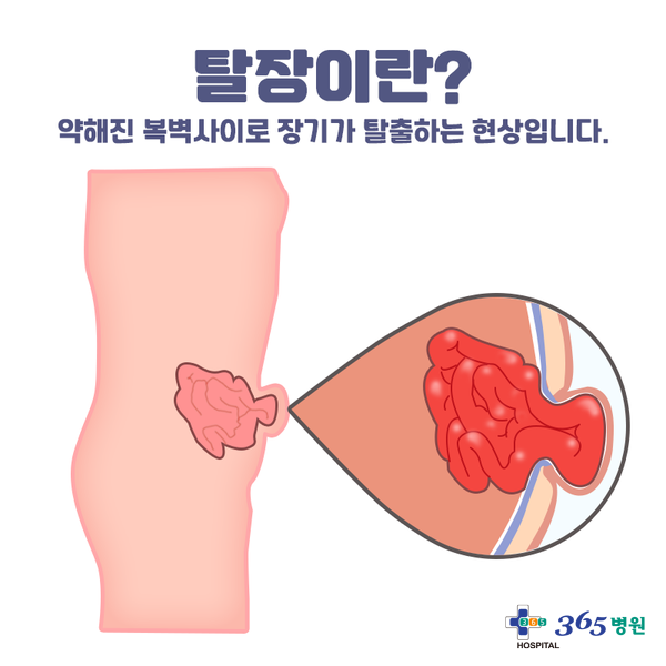  [창원마산 척추관절 디스크 365병원] 탈장