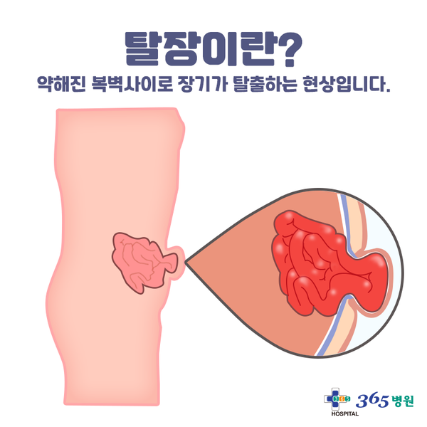 [창원마산 척추관절 디스크 365병원] 탈장