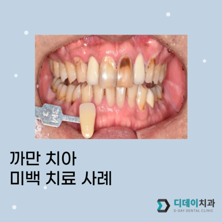  삼성역/대치동 치아미백? 변색된 치아 치료 사례