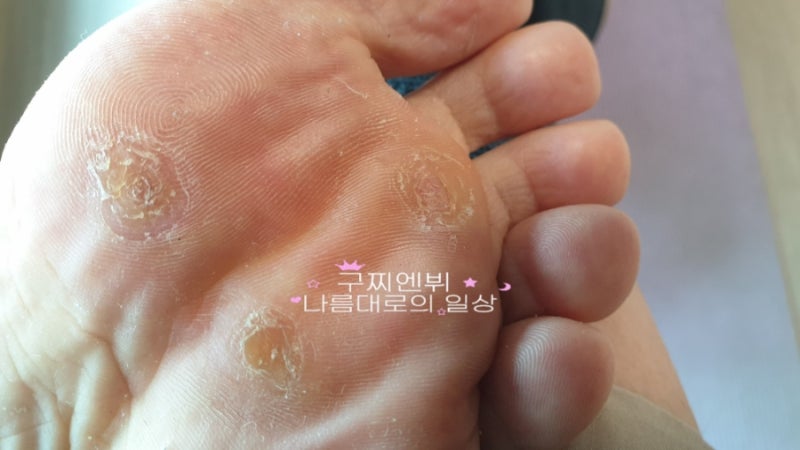족저사마귀 냉동치료 베루말 율무가루 엔드와츠 콜로덤에스액 중 다해보고 완치한 방법?