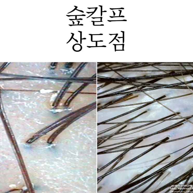  동작구탈모케어는 상도동두피관리 숲칼프