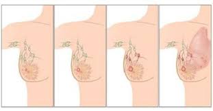  유방암 원인 대표증상징후 위험요인 산부인과진단검사 암종양크기 전이단계 예후경과 통증멍울덩어리 간호진단과정