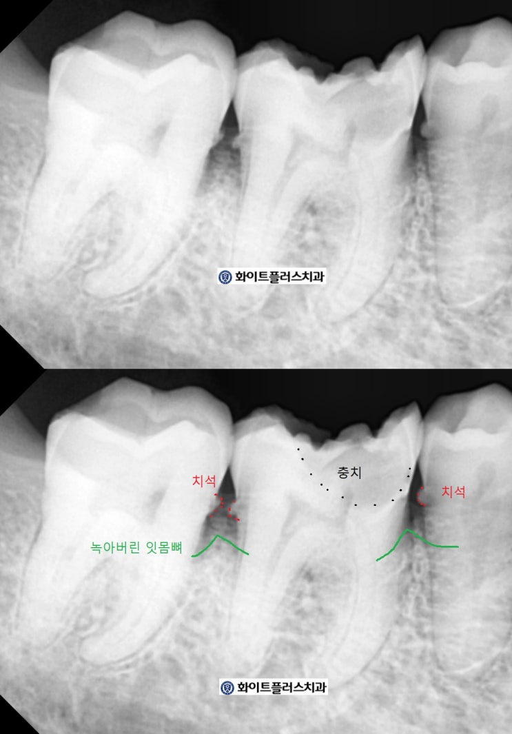 신길동 치과 - 잇몸치료를 통해 잇몸속 치은연하 치석을 제거한 사례