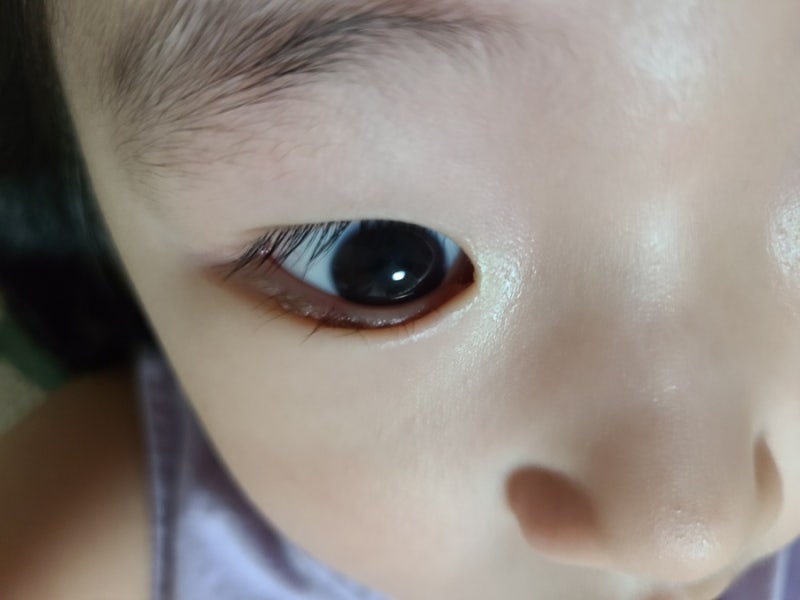 유아안검성형 처진 눈꺼풀 속눈썹 찔러 5세 대구가톨릭병원 김근해 교수