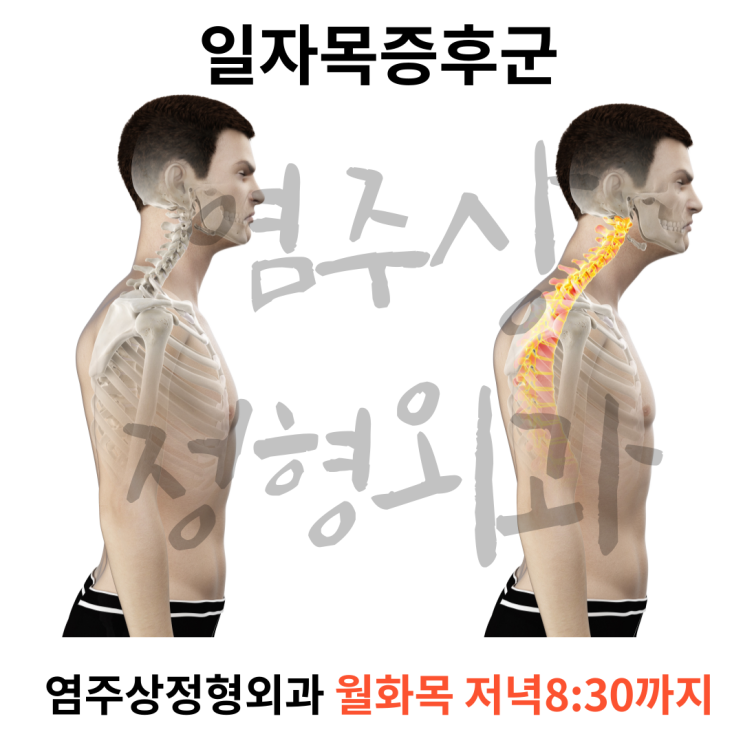  마곡정형외과 도수치료로 일자목이 목디스크로의 악화, 막을수 있습니다 [발산역 염주상정형외과]