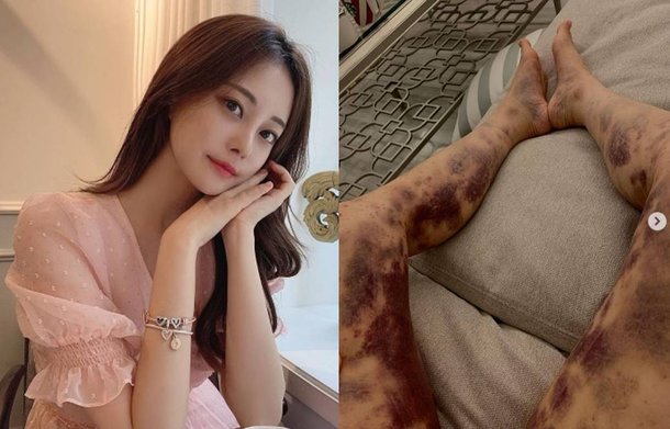  아옳이 건강주사 대학병원 검사 기흉?