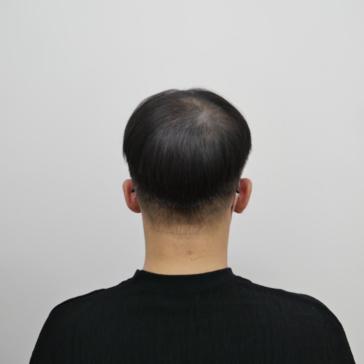  의정부 탈모 smp 민락동 모닷 3회받은 찐후기