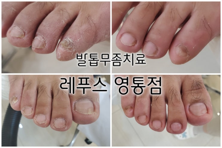 발톱무좀 치료 레푸스 수원영통점 레푸스 가격도 좋네요 발톱무좀 치료 레푸스 수원영통점 레푸스 가격도 좋네요