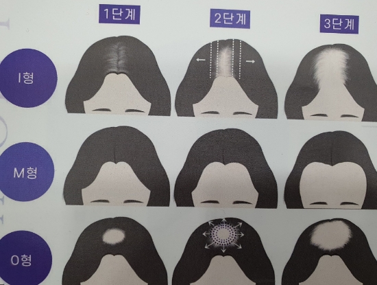  여자가르마탈모 커버  두피문신 으로 적극대처!