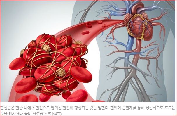  비장혈전이라는 질병이 나의 친구가 되려나.