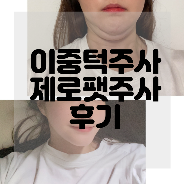 강남브이라인주사 얼굴제로팻 얼굴지방흡입효과 인정