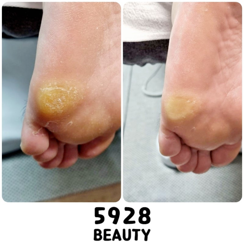 발가락 굳은살 제거 집에서 해결 4